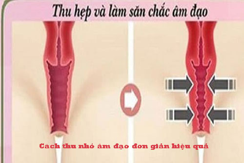 Cách thu nhỏ âm đạo tại nhà
