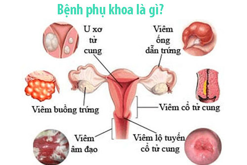 Các bệnh phụ khoa thường gặp ở phụ nữ và cách phòng ngừa