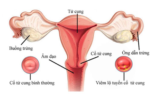 Viêm lộ tuyến cổ tử cung là gì? nguyên nhân, cách chữa